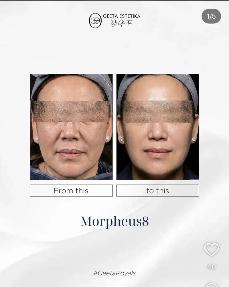 Treatment Morpheus Dr. Geeta