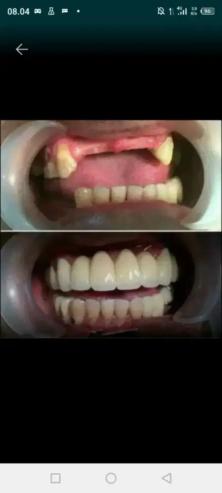 Pasang Gigi palsu higenis