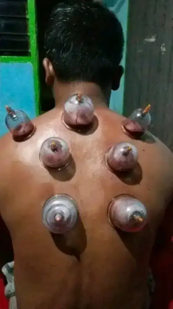 Jasa Bekam dan pijat