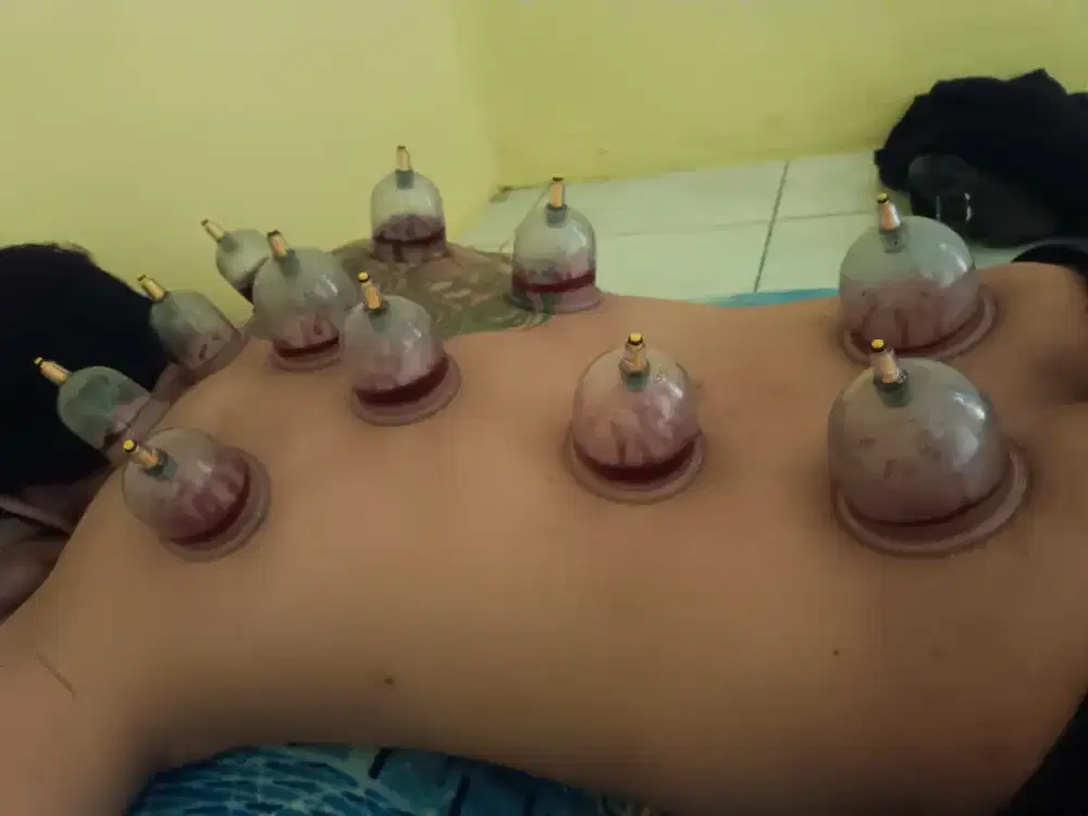 Jasa Terapi Bekam Khusus Pria