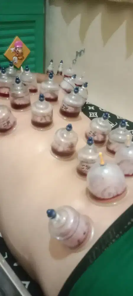 terapi bekam hijamah