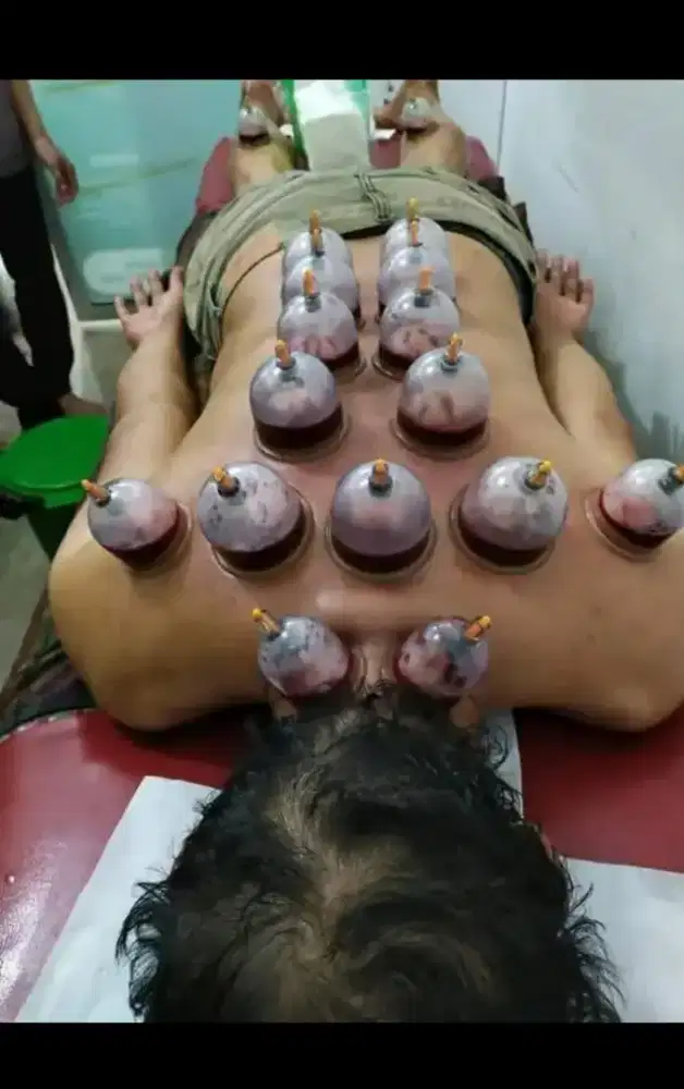 Bekam untuk berbagai keluhan seperti pegel lelah