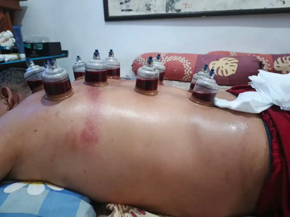 Jasa panggilan bekam basah