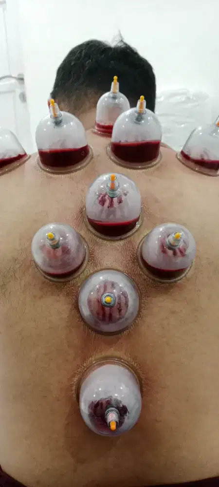 Terapi Bekam  Homecare