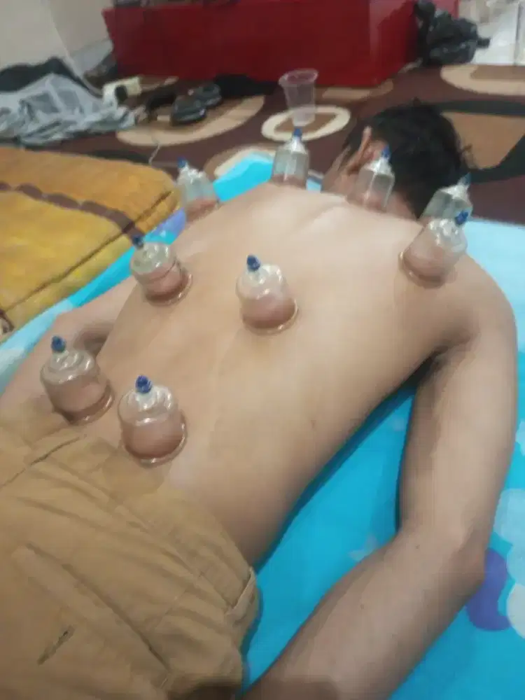 Bekam sunah nabi
