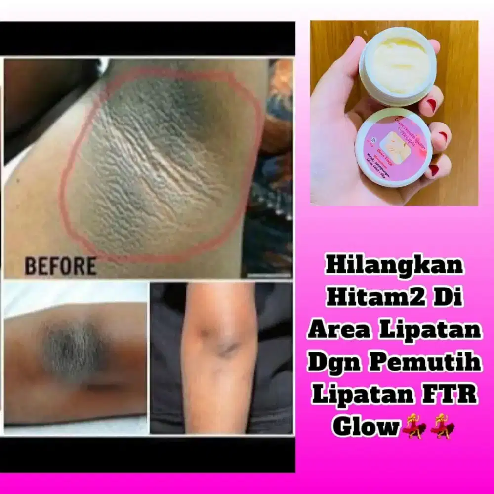 CREAM PEMUTIH LIPATAN KETIAK DAN SELANGKANGAN