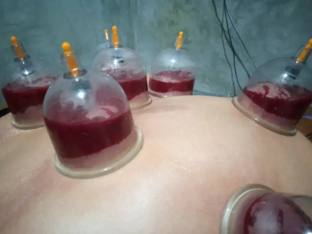Bekam Malang Bisa di Panggil