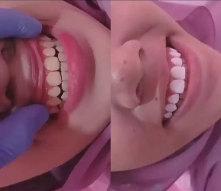 Sebelum&sesudah pasang veneer gigi