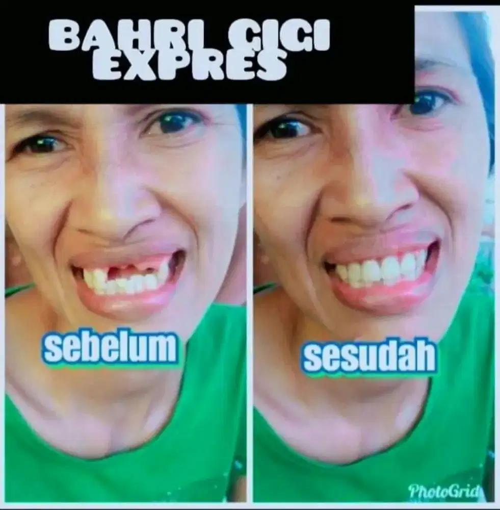 Pasang gigi palsu rapi terlaris