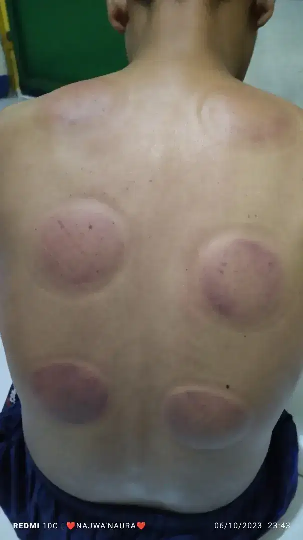 Ayo hidup sehat dan bugar dengan bekam