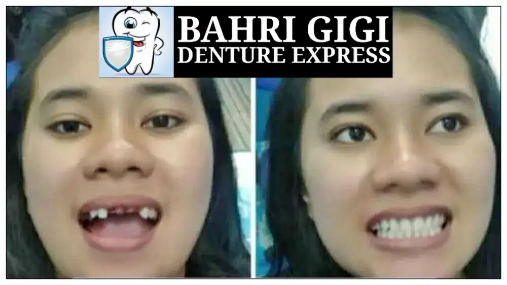 Pasang gigi palsu rapi