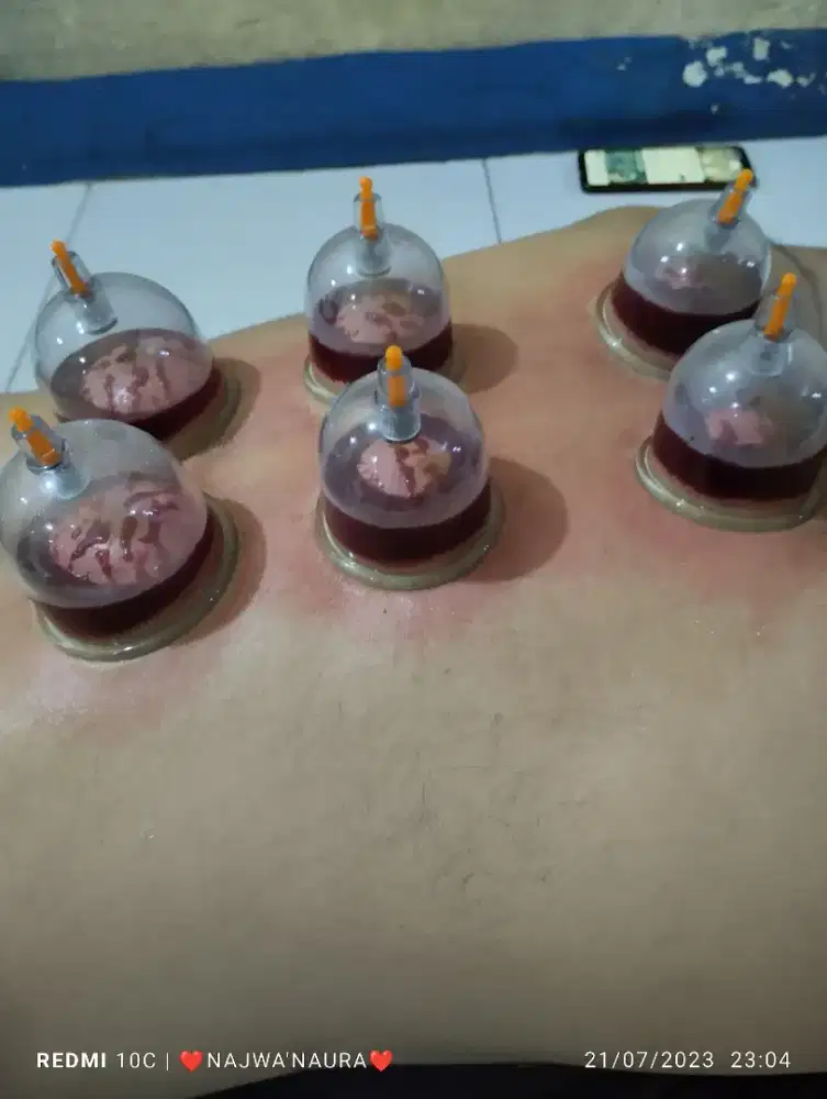 Rutin Bekam per 3 minggu BINAMAS mangga besar