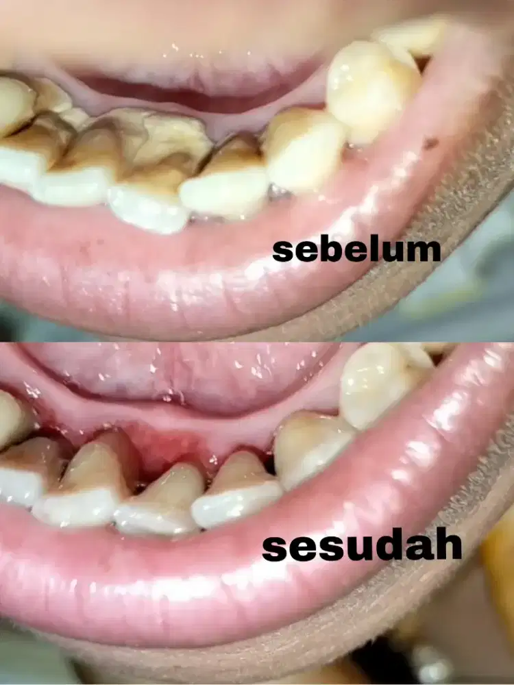 Scaling bersihkan karang gigi