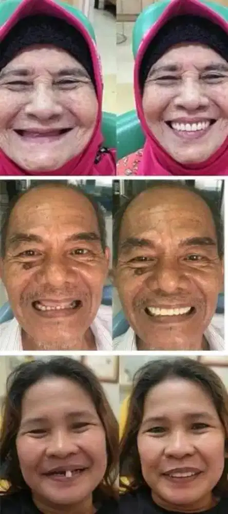 Pasang gigi palsu rapi bergaransi