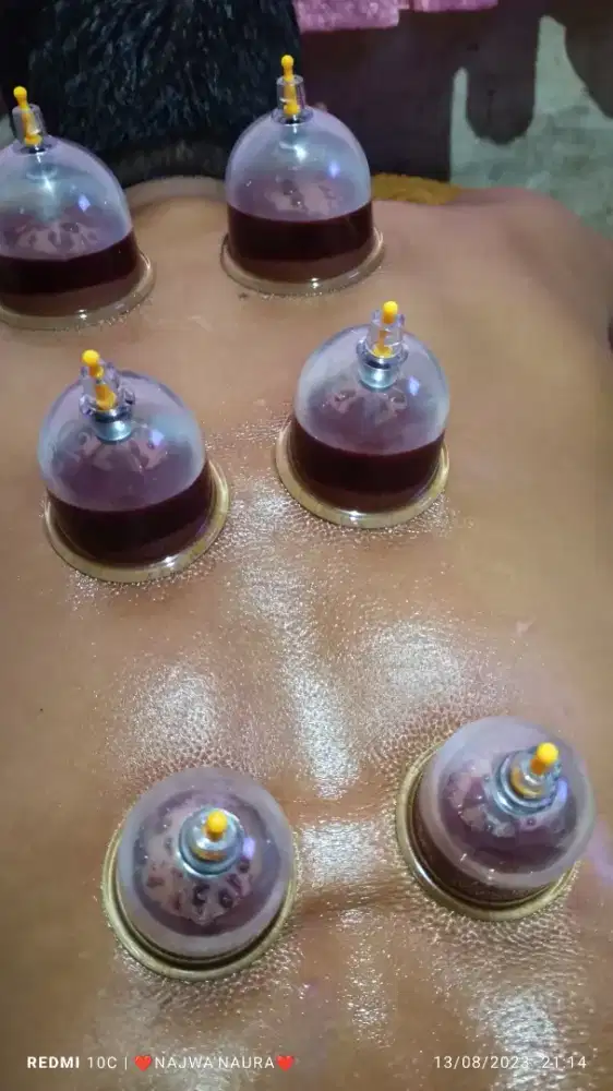 Terapis totok cina dan Bekam