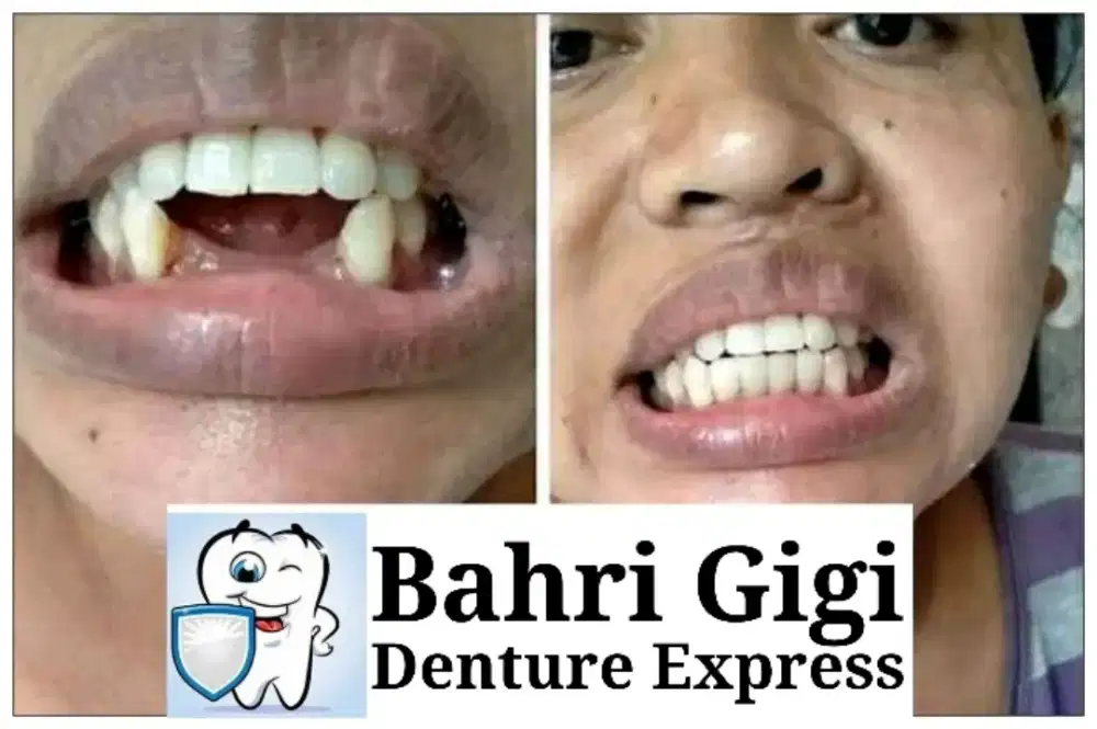 Pasang gigi palsu berkualitas