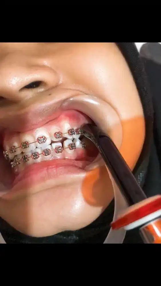 Pasang behel permata