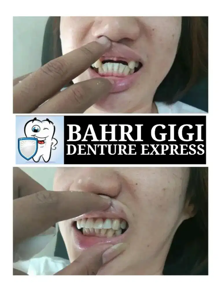 Pasang gigi palsu rapi terjangkau