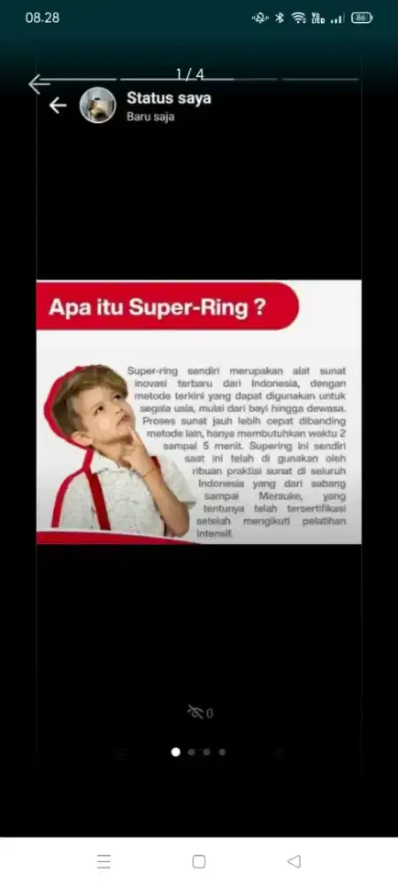 Sunat khitan metode terbaru Super Ring