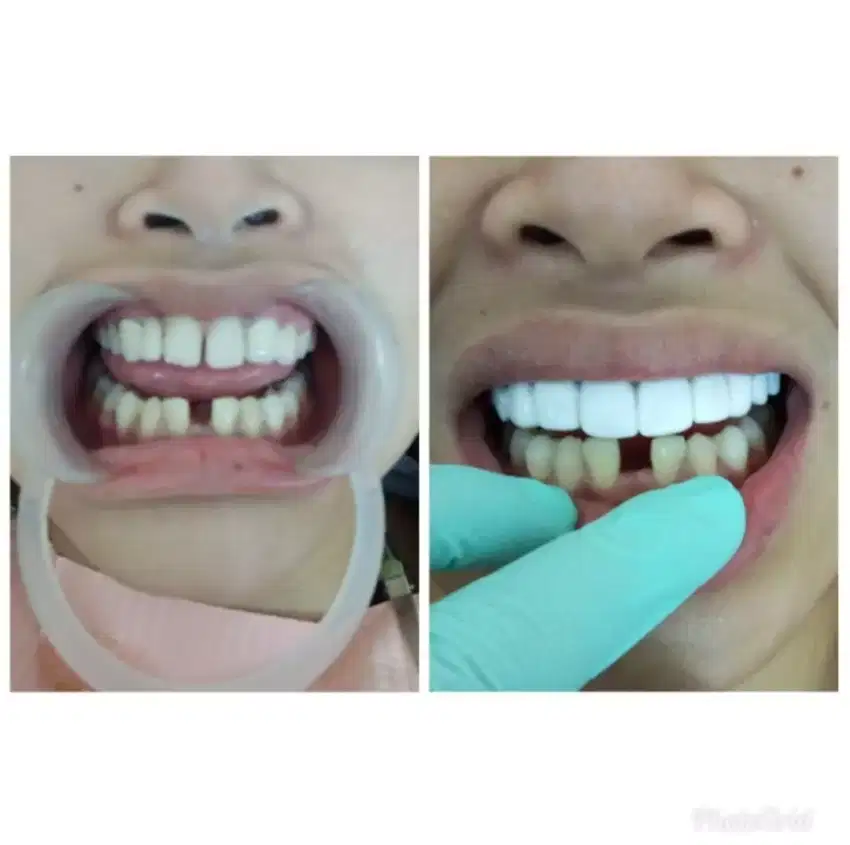 Sebelum&sesudah veneer Gigi