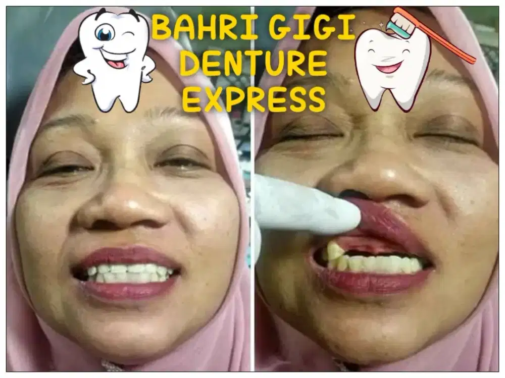 Pasang gigi palsu bergaransi