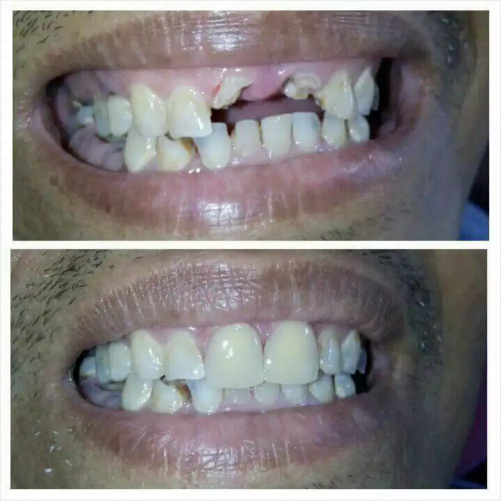 SERVIS GIGI PATAH,GIGI KROPOS DAN PASANG GIGI