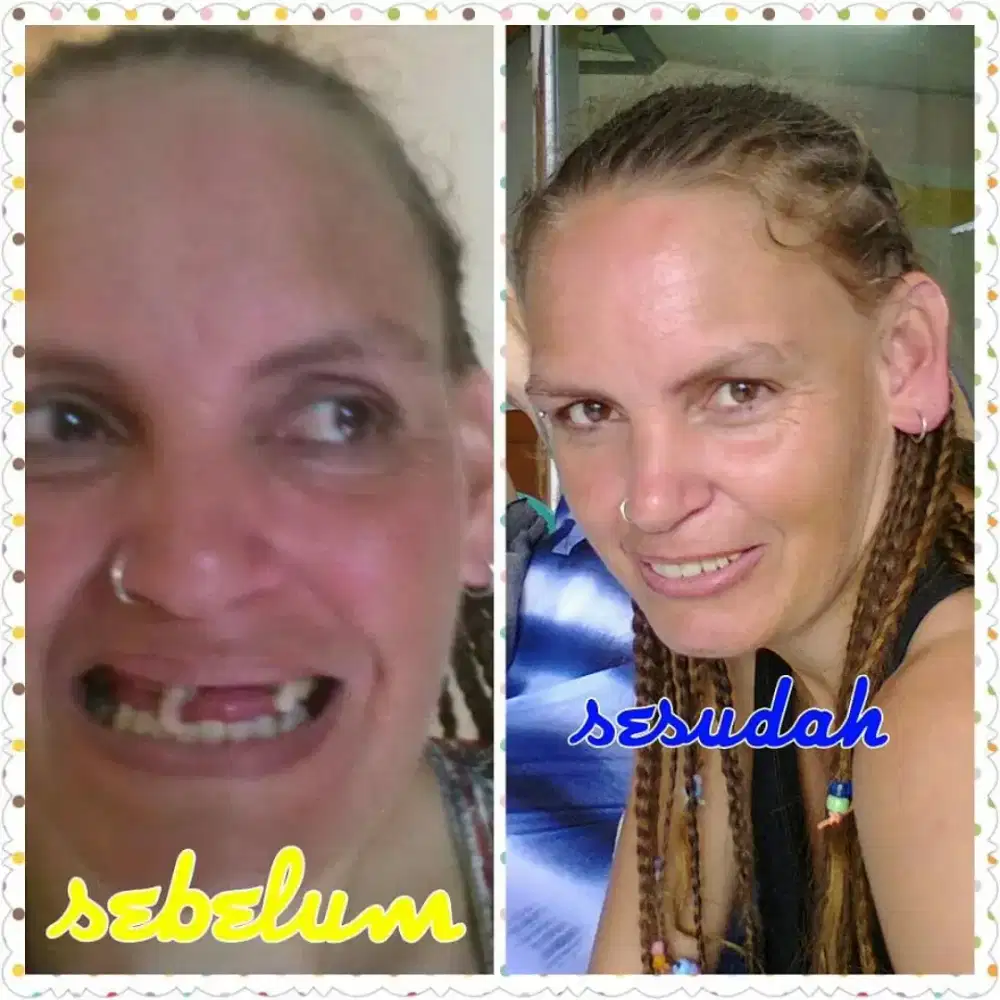 Pasang gigi palsu rapi murah