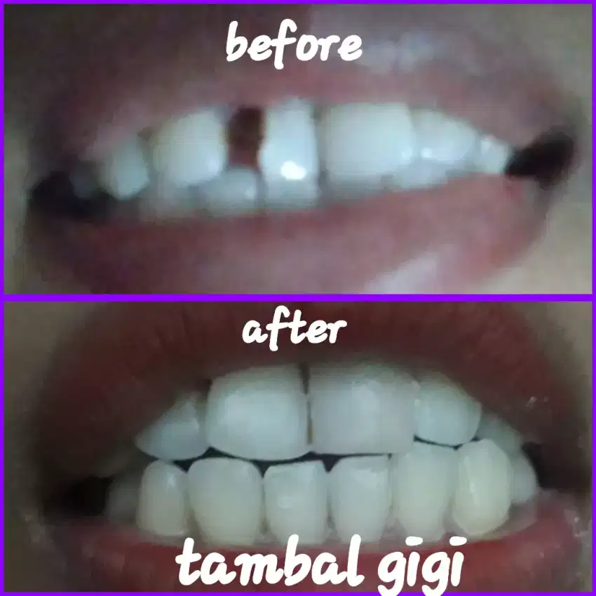 TAMBAL GIGI PERMANEN