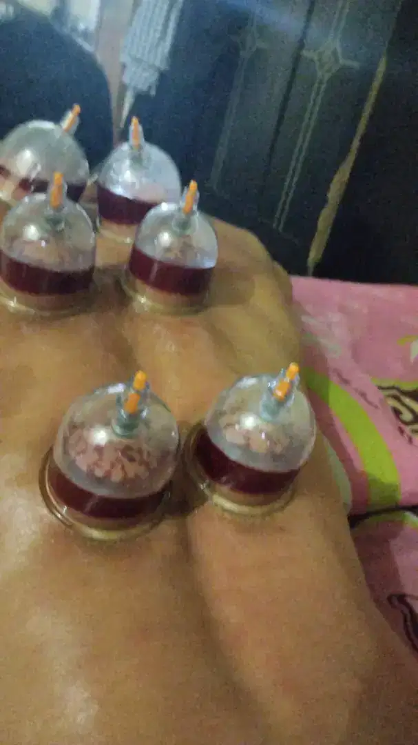 Terapi bekam dan totok chuzhen panggilan