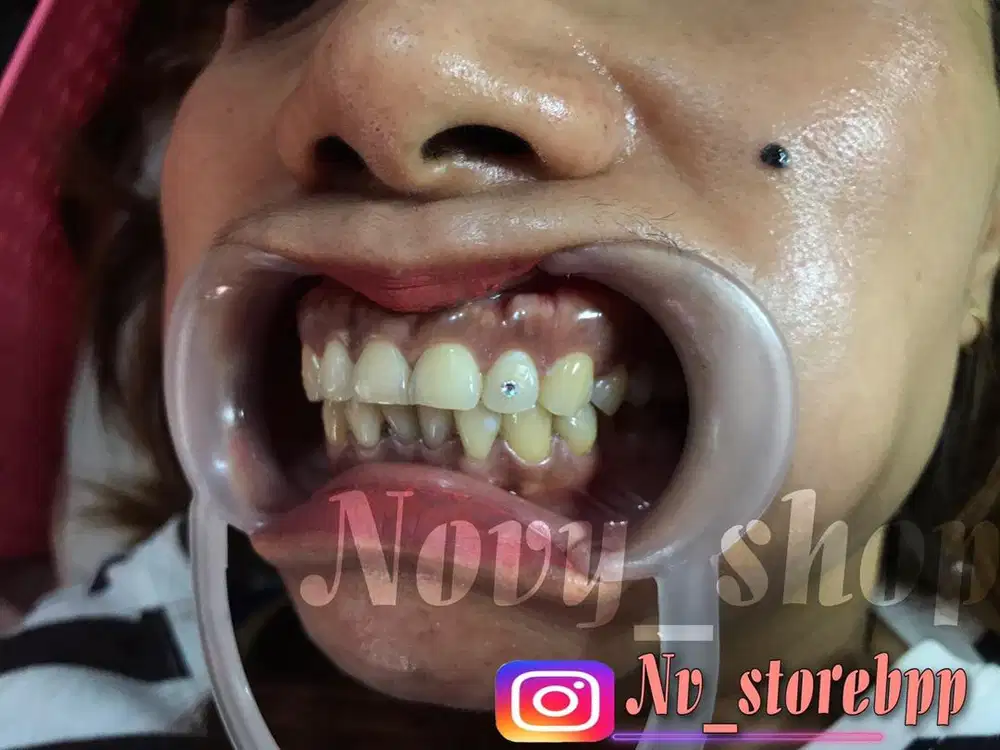 Diamond permata gigi