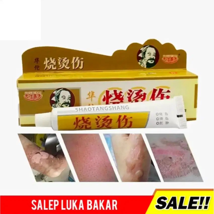 SALEP CINA ATASI LUKA BAKAR