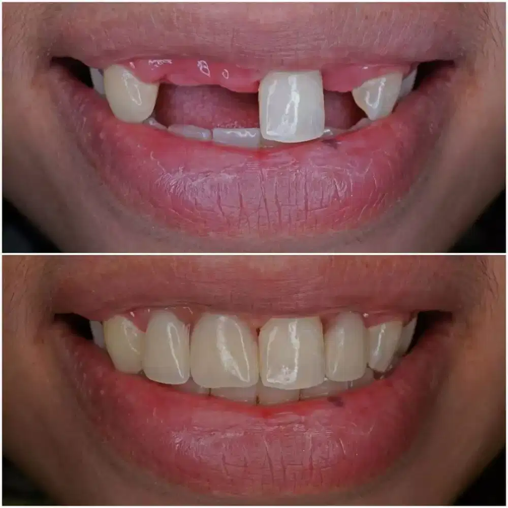 PASANG GIGI DAN TAMBAL GIGI