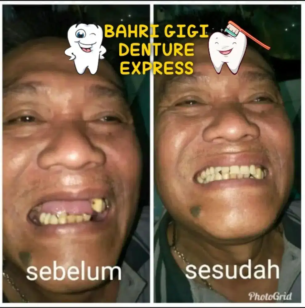 Pasang gigi palsu berkualitas bergaransi