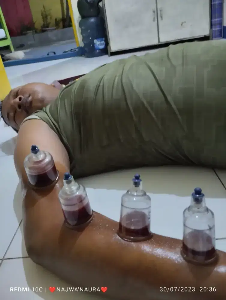 Tangan jadi enteng tidak kaku setelah bekam dan juga tidur nyenyak..