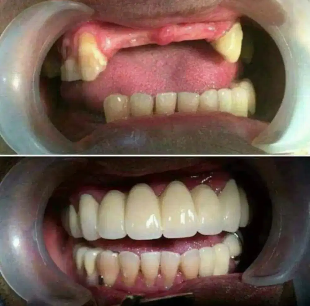 GIGI TIRUAN AKURAT HASILNYA