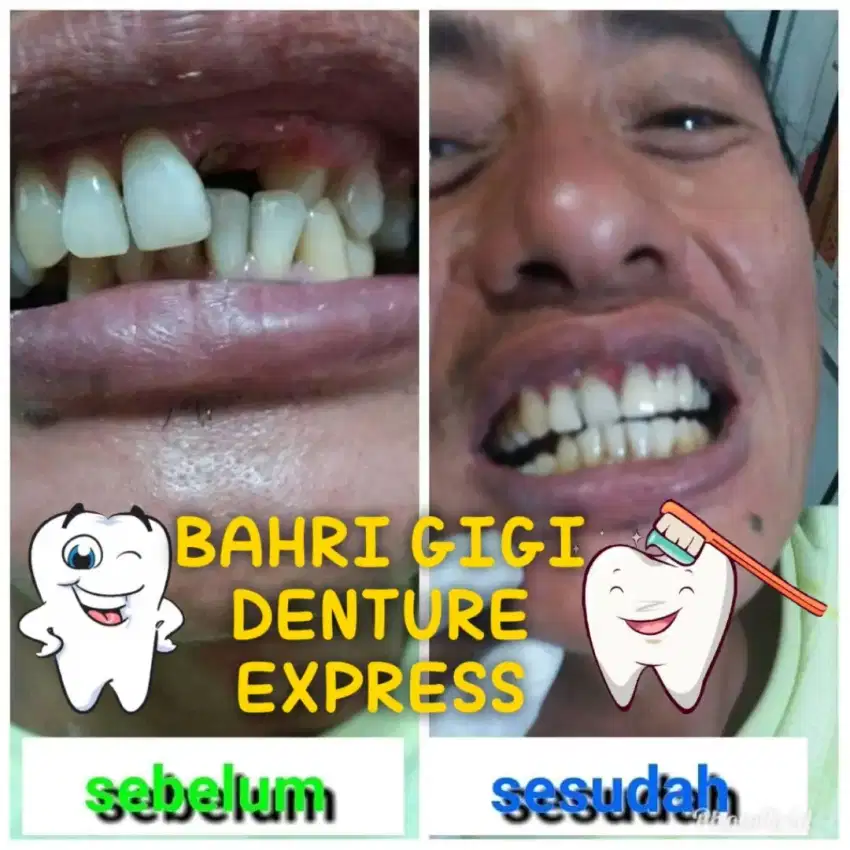 Pasang gigi palsu murah bergaransi