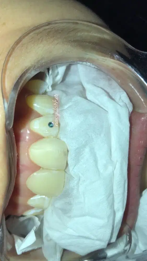 permata gigi mutiara