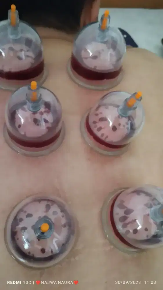 Sehat dan bugar bersama totok chuzhen dan Bekam