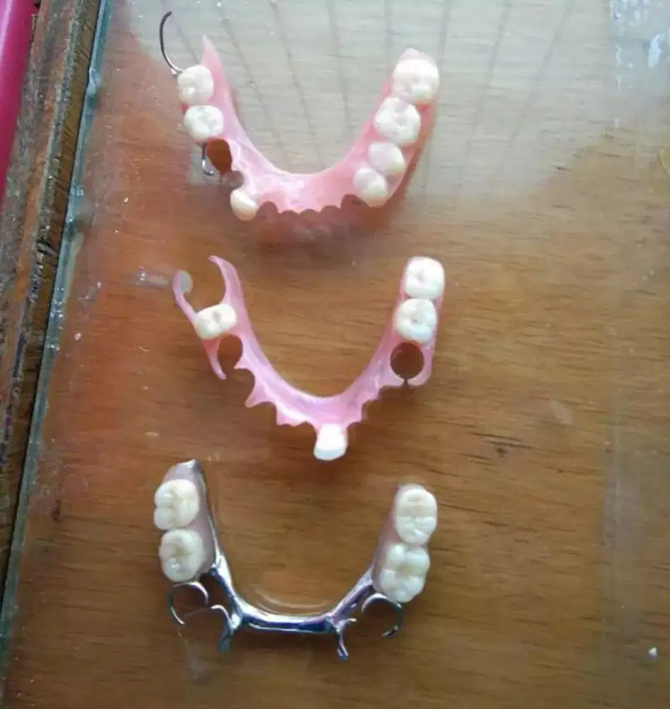 GIGI VALPLAST DAN AKRILIK