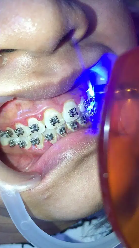 Pasang BEHEL / diamond permata gigi