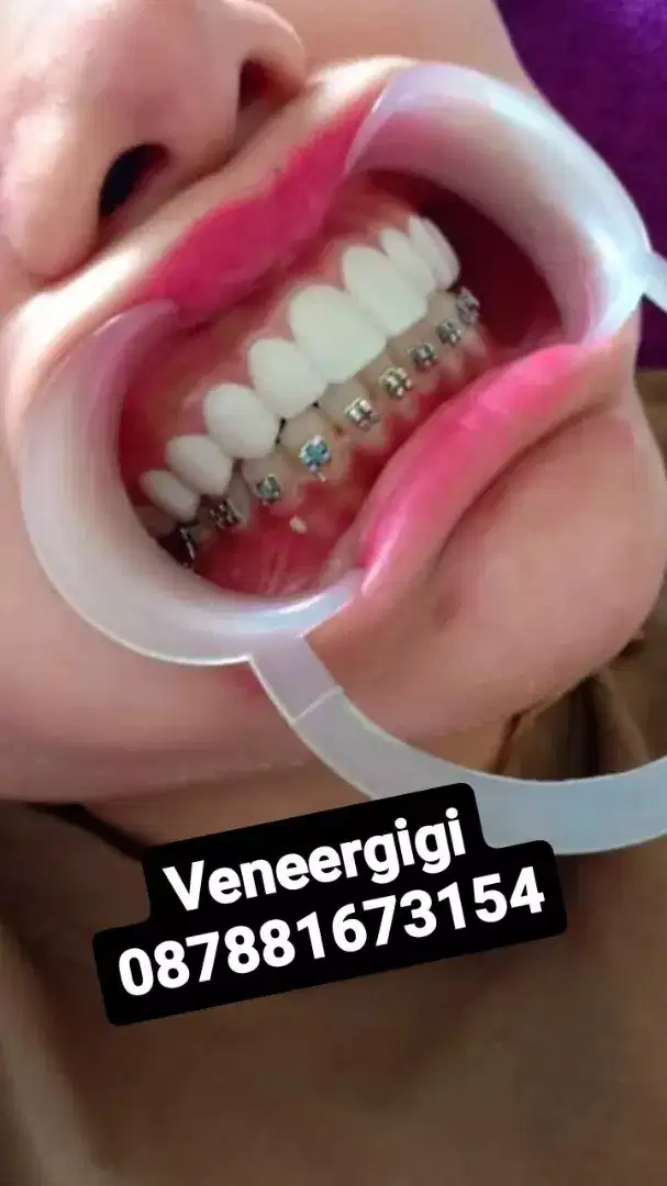 Veneer gigi panggilan