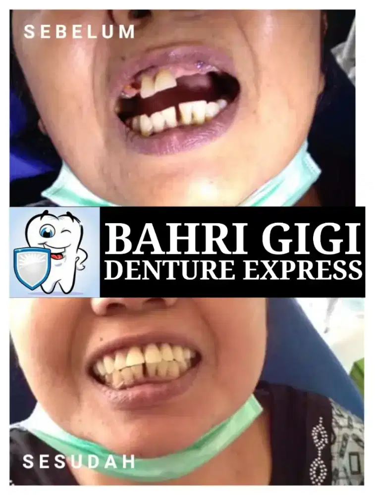 Pasang gigi palsu terjangkau berkualitas