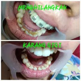 BLEACING DAN BERSIHIN KARANG GIGI