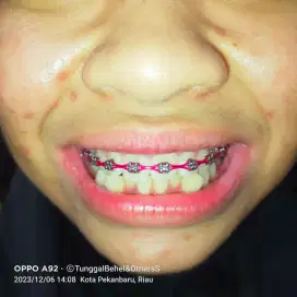 Behel fashion atas atau bawah saja ( 1 rahang )