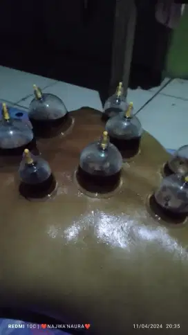 Terapi Pengobatan Bekam