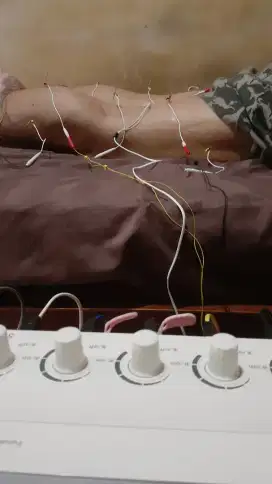 JASA AKUPUNTURIS
