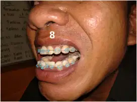 Behel perawatan keramik
