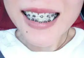 Behel perawatan metalik