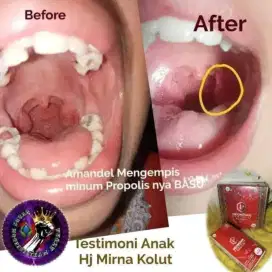 Propolis obat sakit gigi ampuh