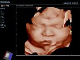 USG 4D mindray seken softcopy video via wifi